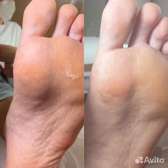 SMART педикюр с покрытием пальчиков