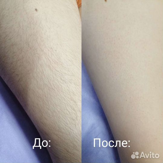 Шугаринг