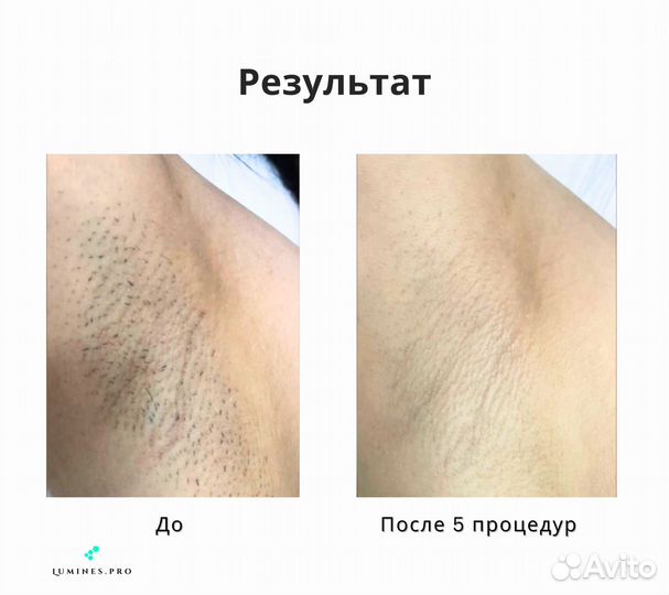 Диодный лазер lumines Макс’Про 2000 Вт