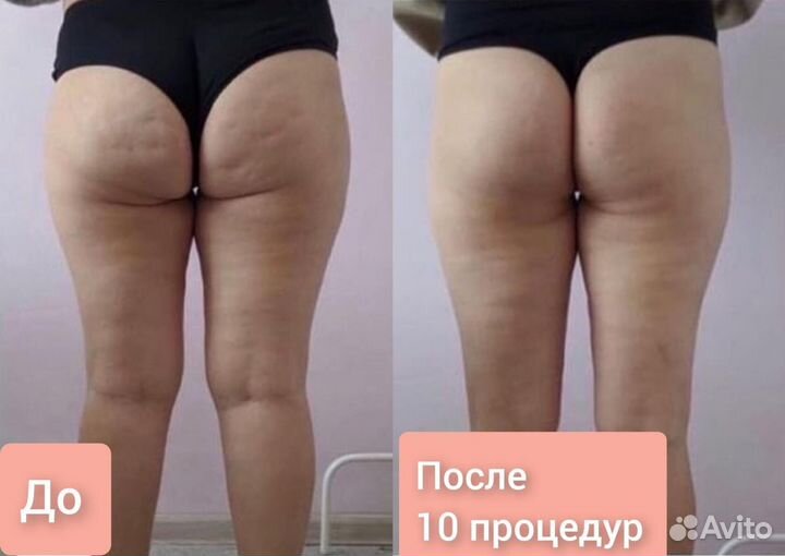 Аппаратный вакуумный массаж, кавитация, и др