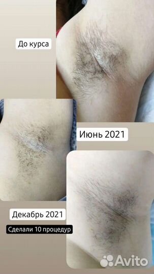 Электроэпиляции избавление от волос