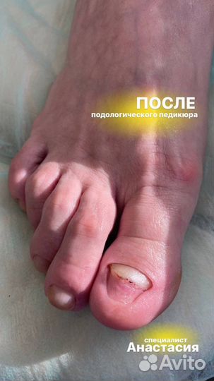 Педикюр Подология Бесплатно консультация