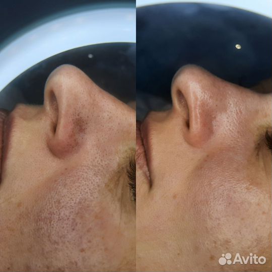 Чистка лица