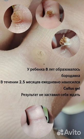 Услуги подолога/ выезд на дом