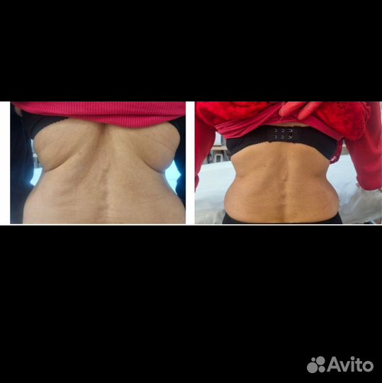 Похудение липолитиками