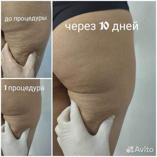 Похудение убираем целлюлит любой стадии. Аппарат