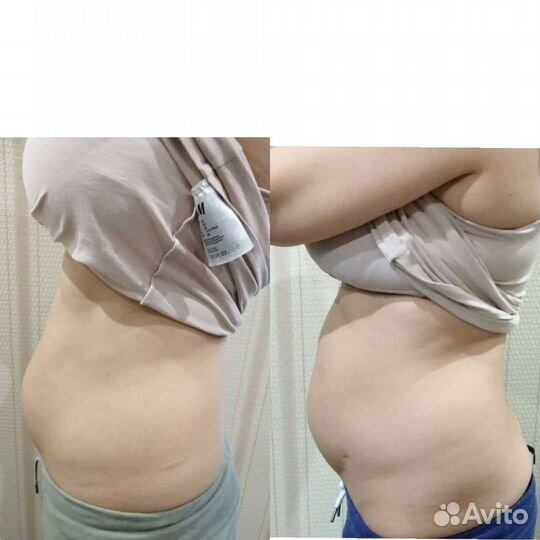 Карамельная липосакция