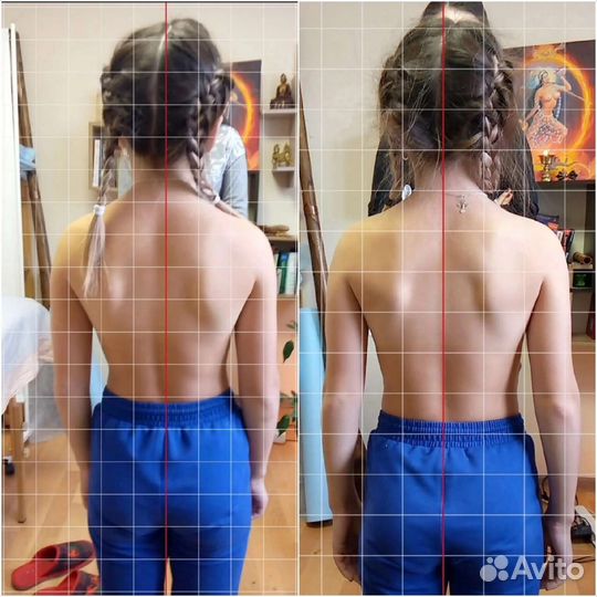 Массаж. Коррекция сколиотической осанки