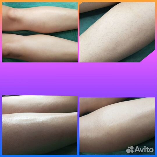 Шугаринг депиляция