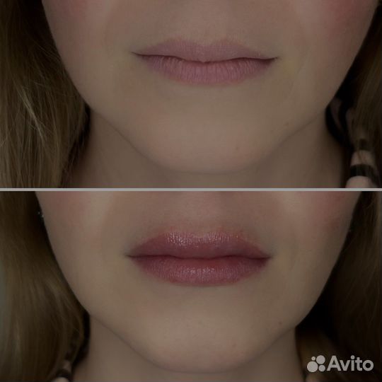 Безыгольное увеличение губ