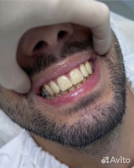 Фотокомпозитные Виниры 5000