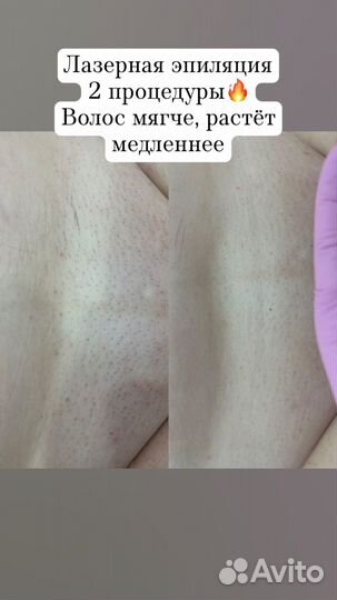 Лазерная эпиляция