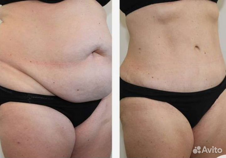 Аппаратный массаж:кавитация, рф-лифтинг липолиз