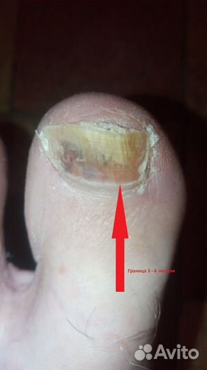 Лечение онихомикоза (грибка ногтей)