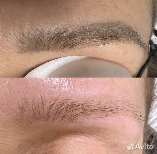 Удаление татуажа и тату лазером требуются модели