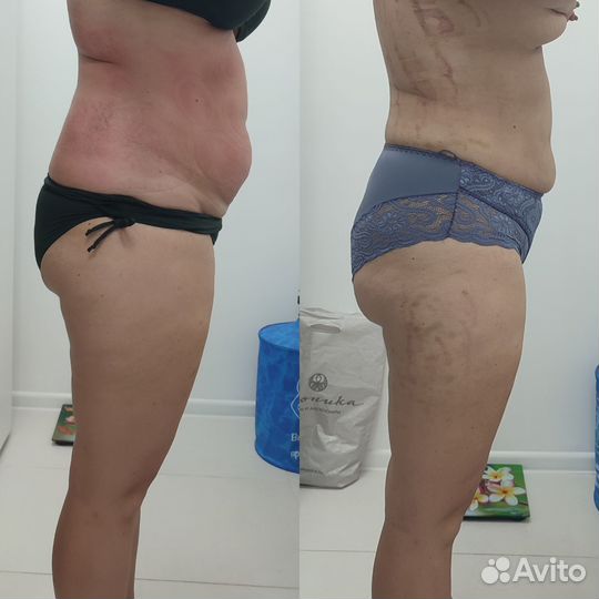 Похудение, Массаж, Аппаратная коррекция фигуры