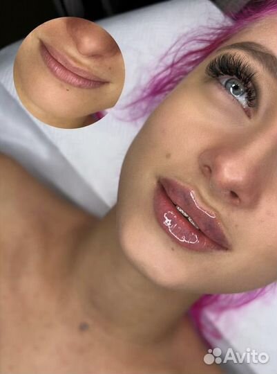 Увеличение Губ Ялта