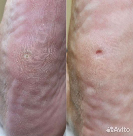 Лечебный (медицинский) педикюр подолог