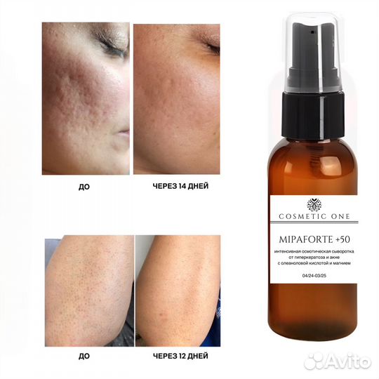 Сыворотка от гиперкератоза и акне