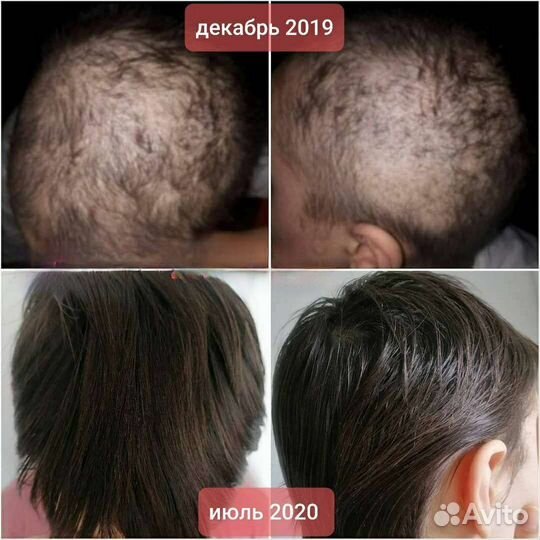 Выпадают волосы