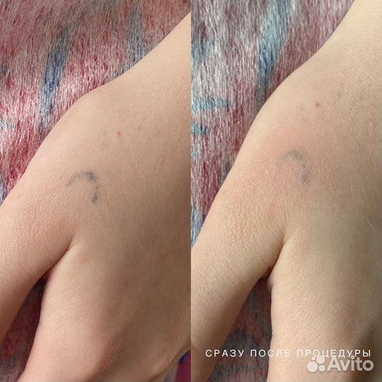 Требуются модели на удаление татуажа