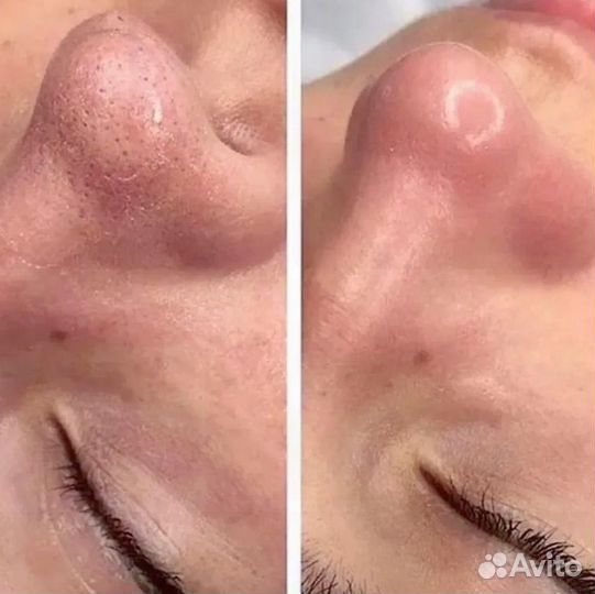 Косметолог. Чистка лица, лечение акне, омоложение