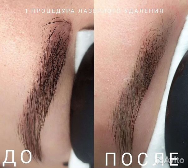 Удаление татуажа и татуировок