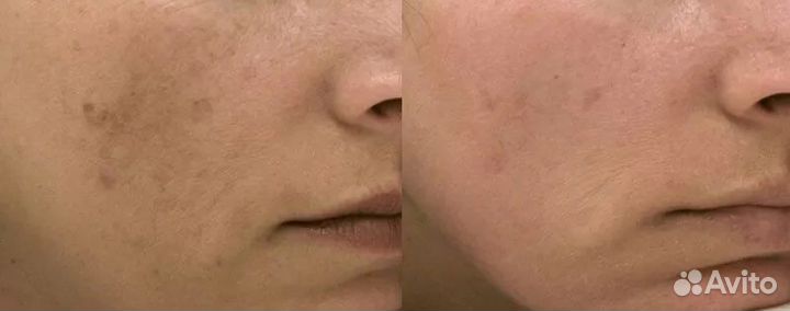 Карбоновый пилинг