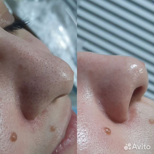 Чистка лица