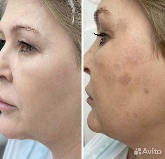 Лазерная эпиляция, элос эпиляция, элос омоложение