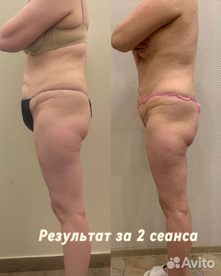 Аппаратный LPG вакуумный массаж вибромассаж