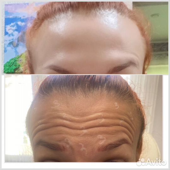 Ботокс.Устранение морщин