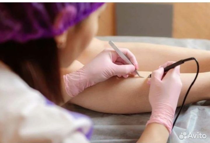 Электроэпиляция