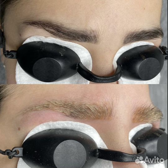 Удаление перманентного макияжа