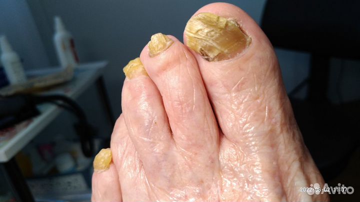 Педикюр(медицинский) Выезд