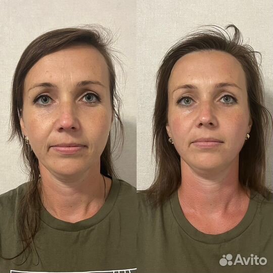 Миофасциальный массаж+Буккальный массаж