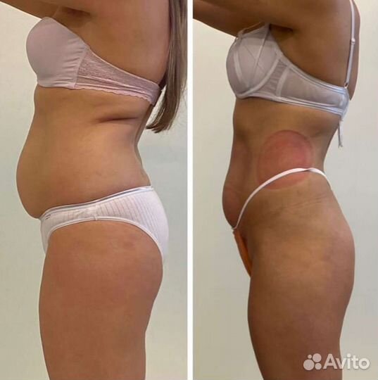 Криолиполиз