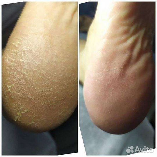 Аппаратный педикюр с 8ч до 22ч ежедневно