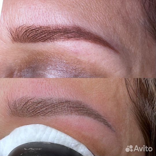 Удаление татуажа бровей, губ, татуировок