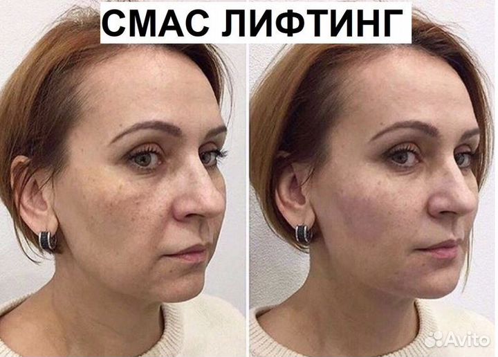 СМАС лифтинг для лица