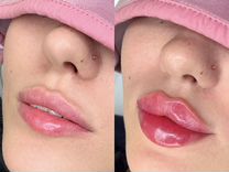 Косметолог Увеличение губ