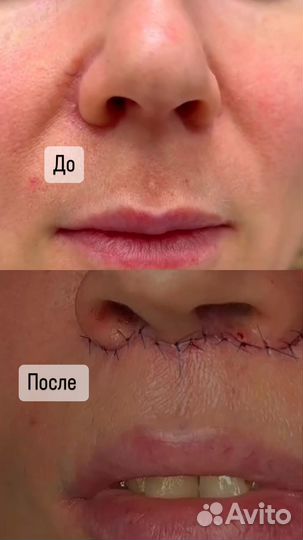 Булхорн броулифтинг