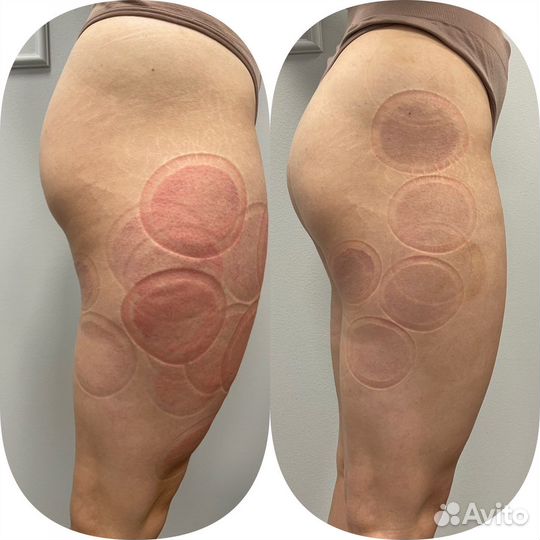 Аппаратное похудение Коррекция фигуры