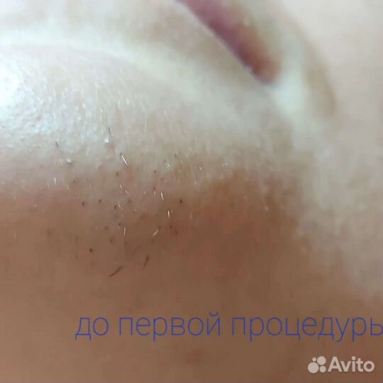 Электроэпиляция