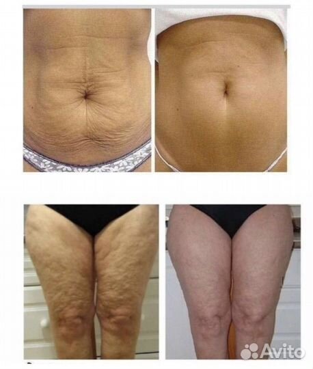 Антицеллюлитный массаж