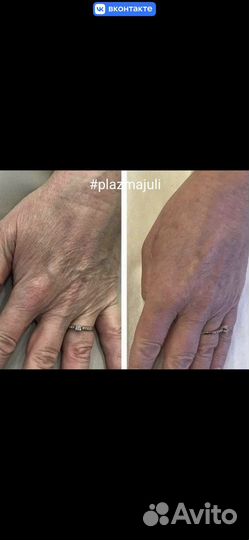 Холодная плазма