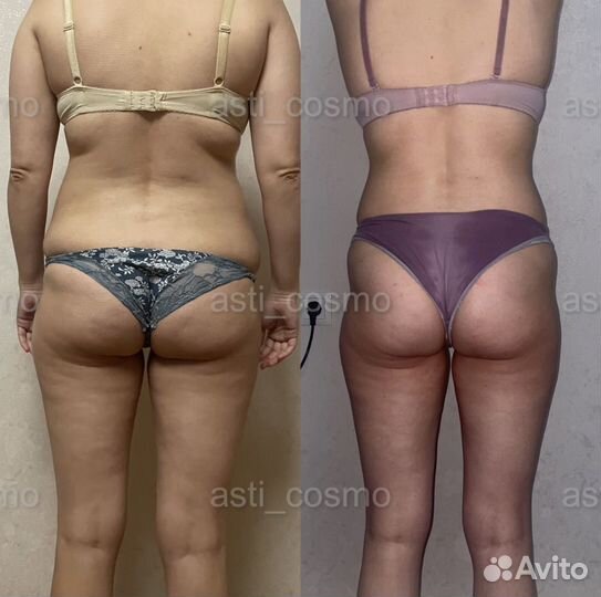 Похудение/Антицеллюлитный массаж/Массаж