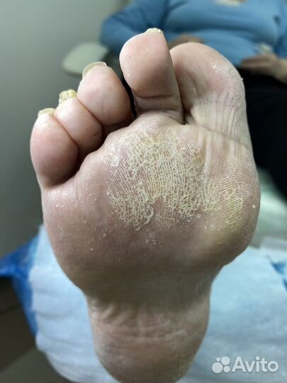 Подолог/Педикюр/Вросший ноготь/Мозоль