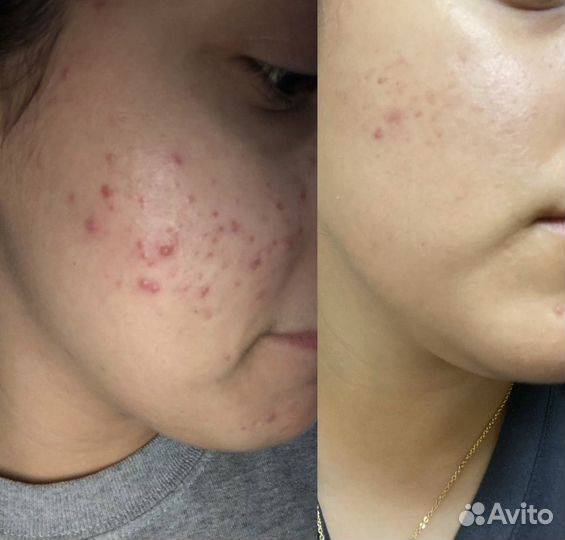 Фракционная мезотерапия