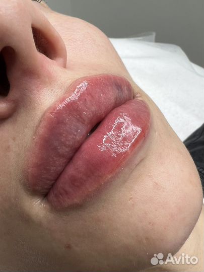 Биоревитализация